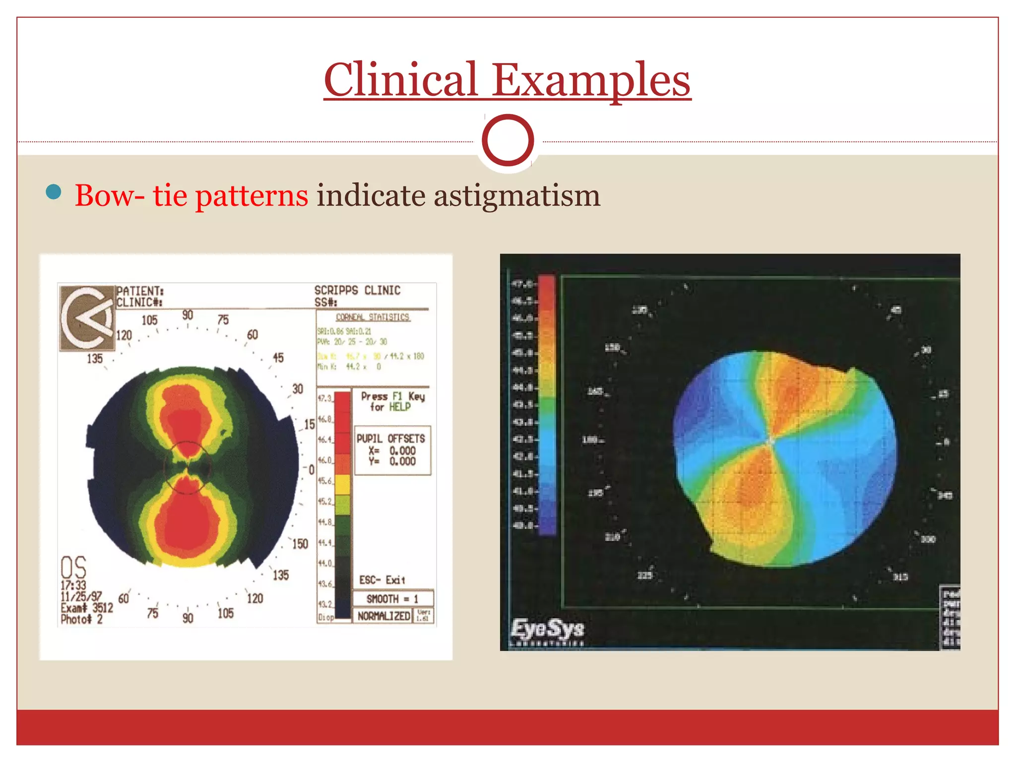 Clinical Examples
Bow- tie patterns indicate astigmatism
 