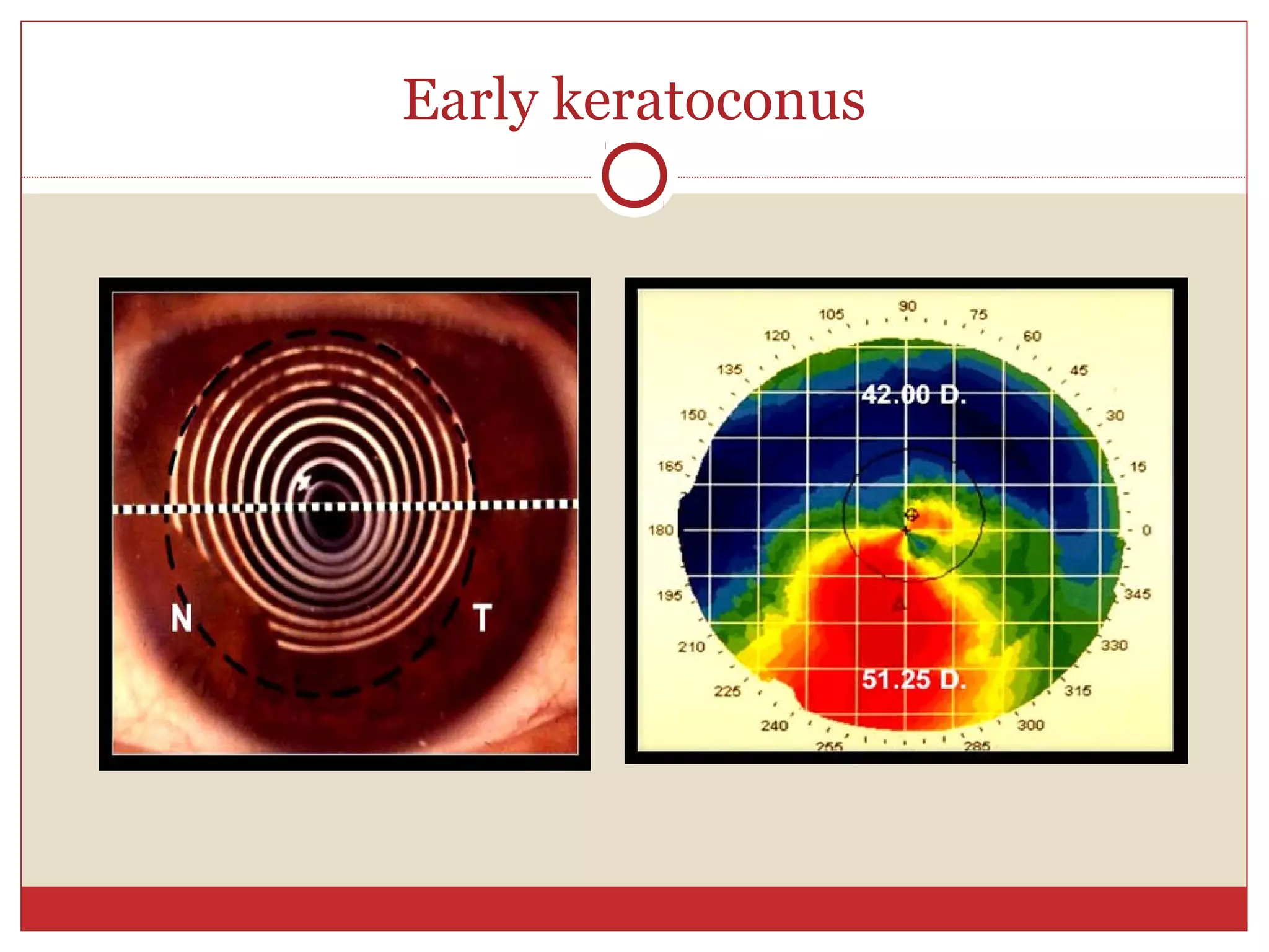 Early keratoconus
 