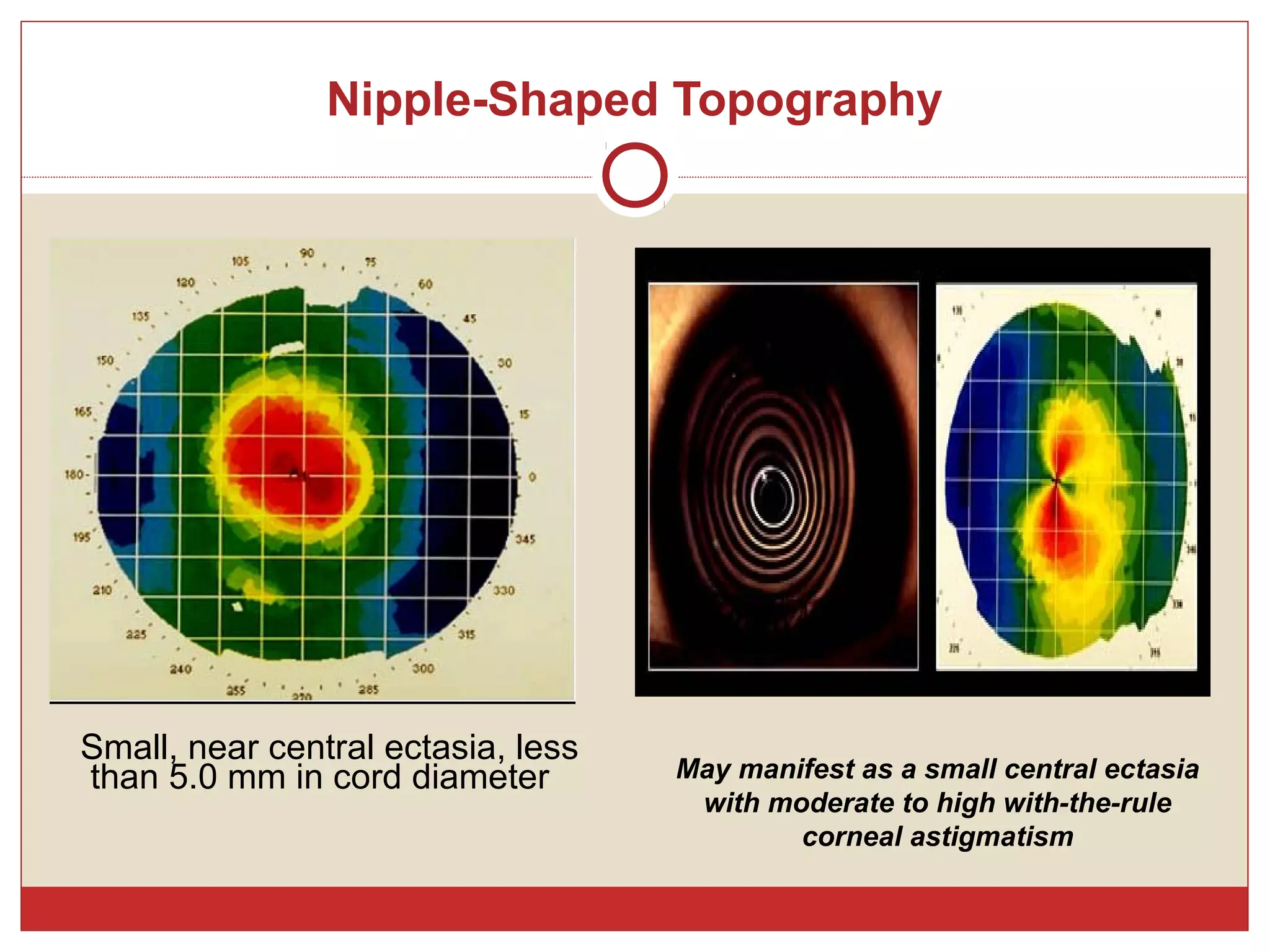 Nipple-Shaped Topography
Small, near central ectasia, less
than 5.0 mm in cord diameter May manifest as a small central ectasia
with moderate to high with-the-rule
corneal astigmatism
 