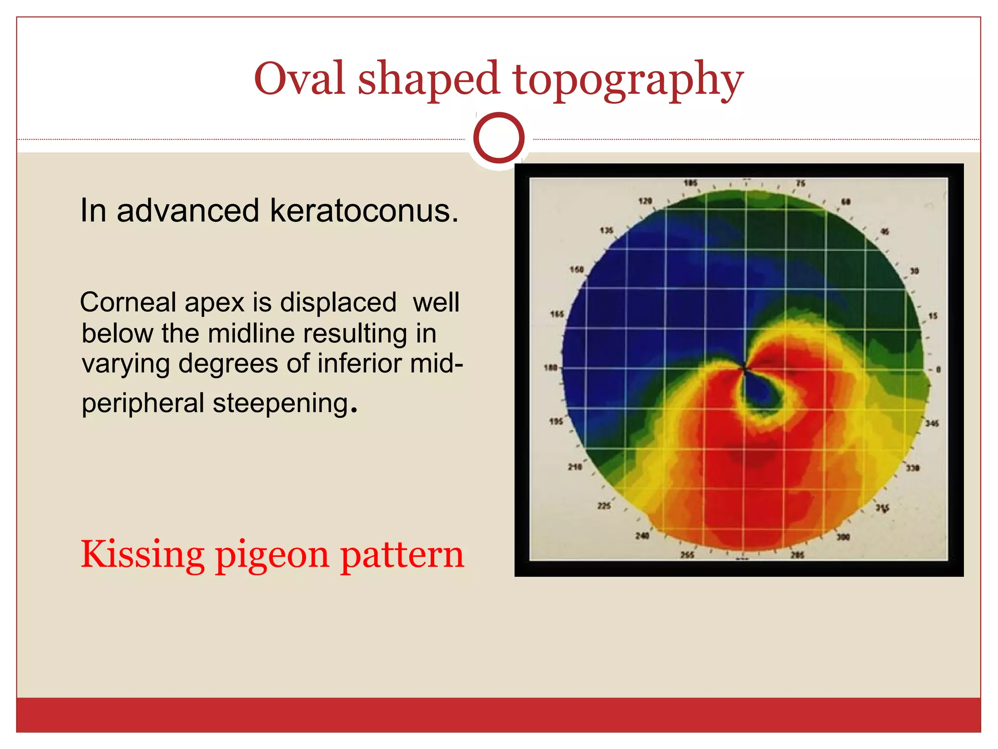 Oval shaped topography
In advanced keratoconus.
Corneal apex is displaced well
below the midline resulting in
varying degrees of inferior mid-
peripheral steepening.
Kissing pigeon pattern
 