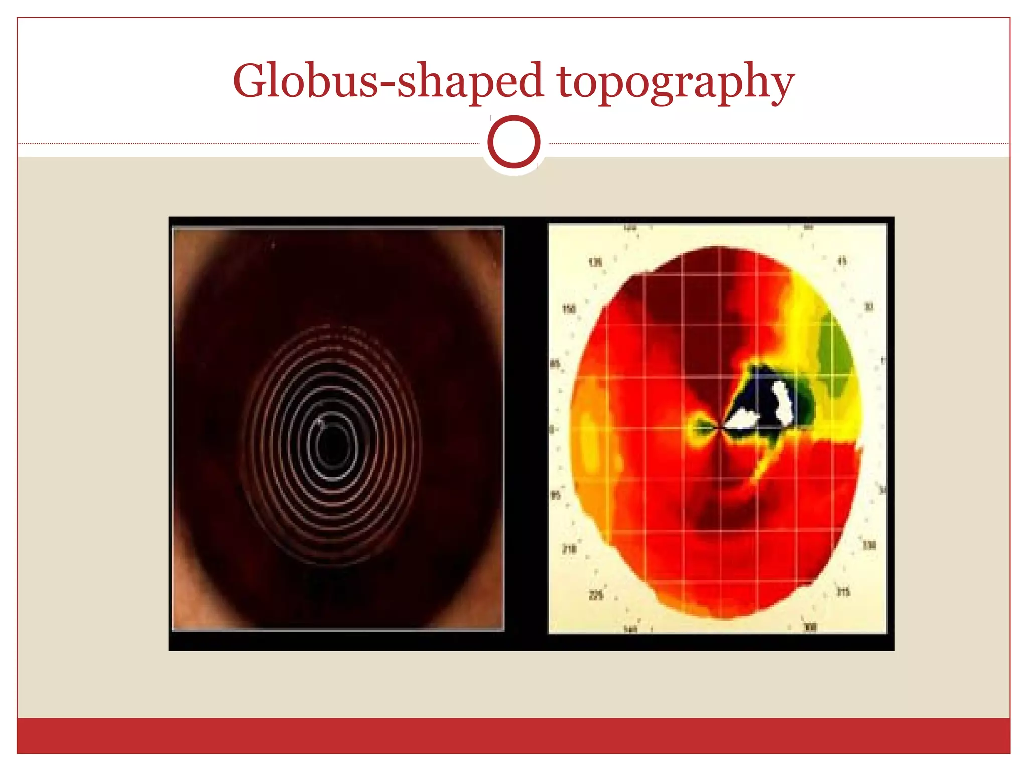 Globus-shaped topography
 