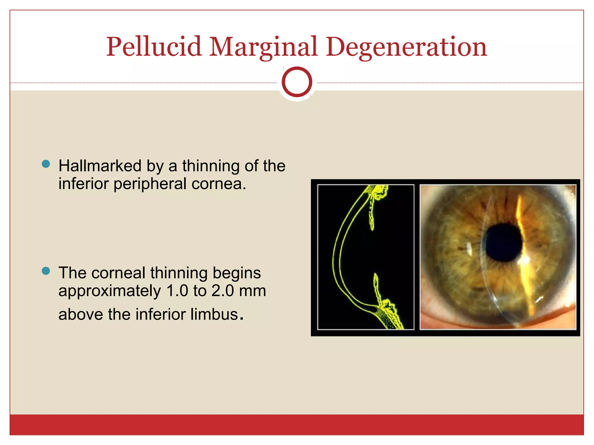 Pellucid Marginal Degeneration
 Hallmarked by a thinning of the
inferior peripheral cornea.
 The corneal thinning begins
approximately 1.0 to 2.0 mm
above the inferior limbus.
 