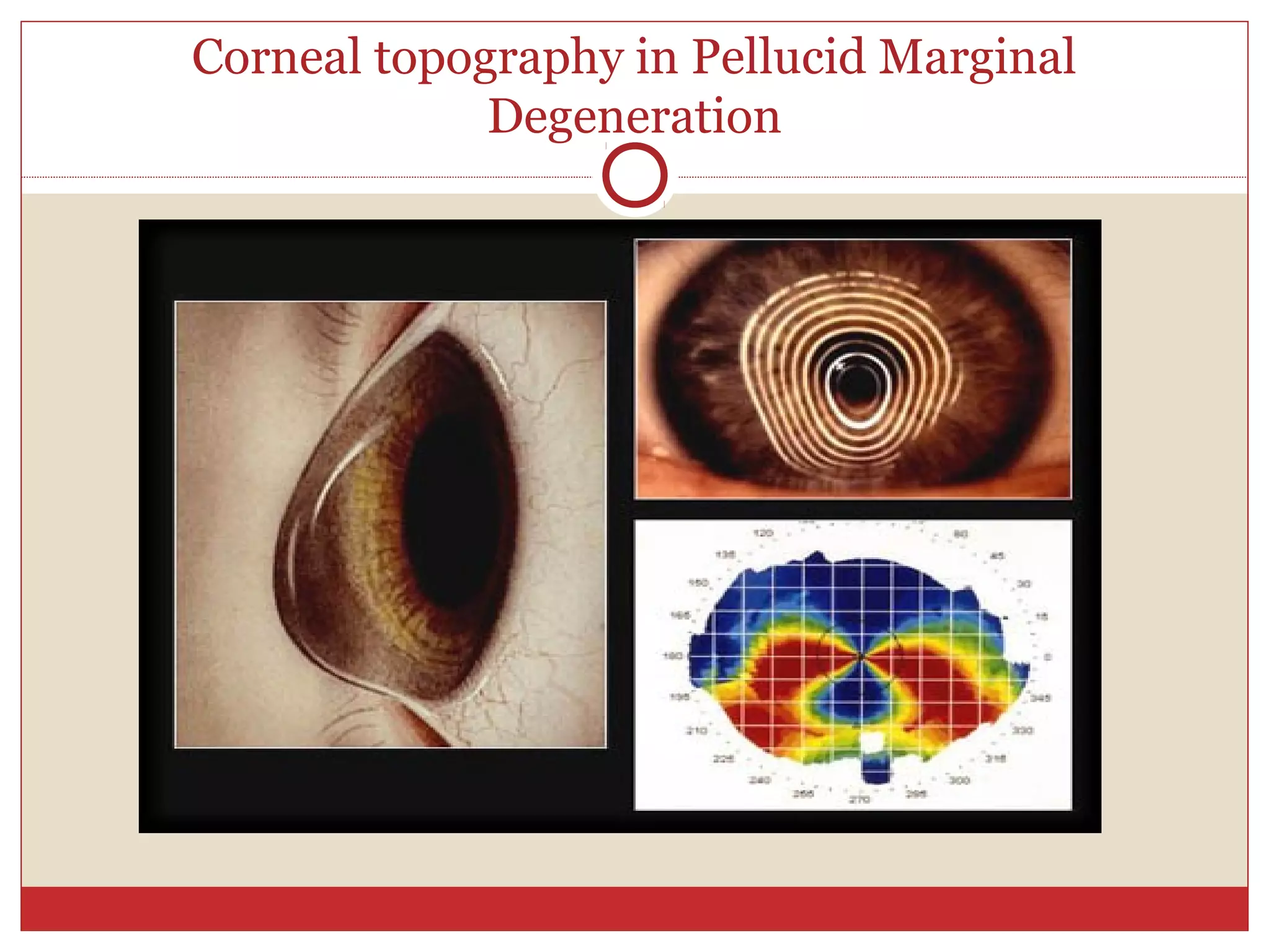 Corneal topography in Pellucid Marginal
Degeneration
 