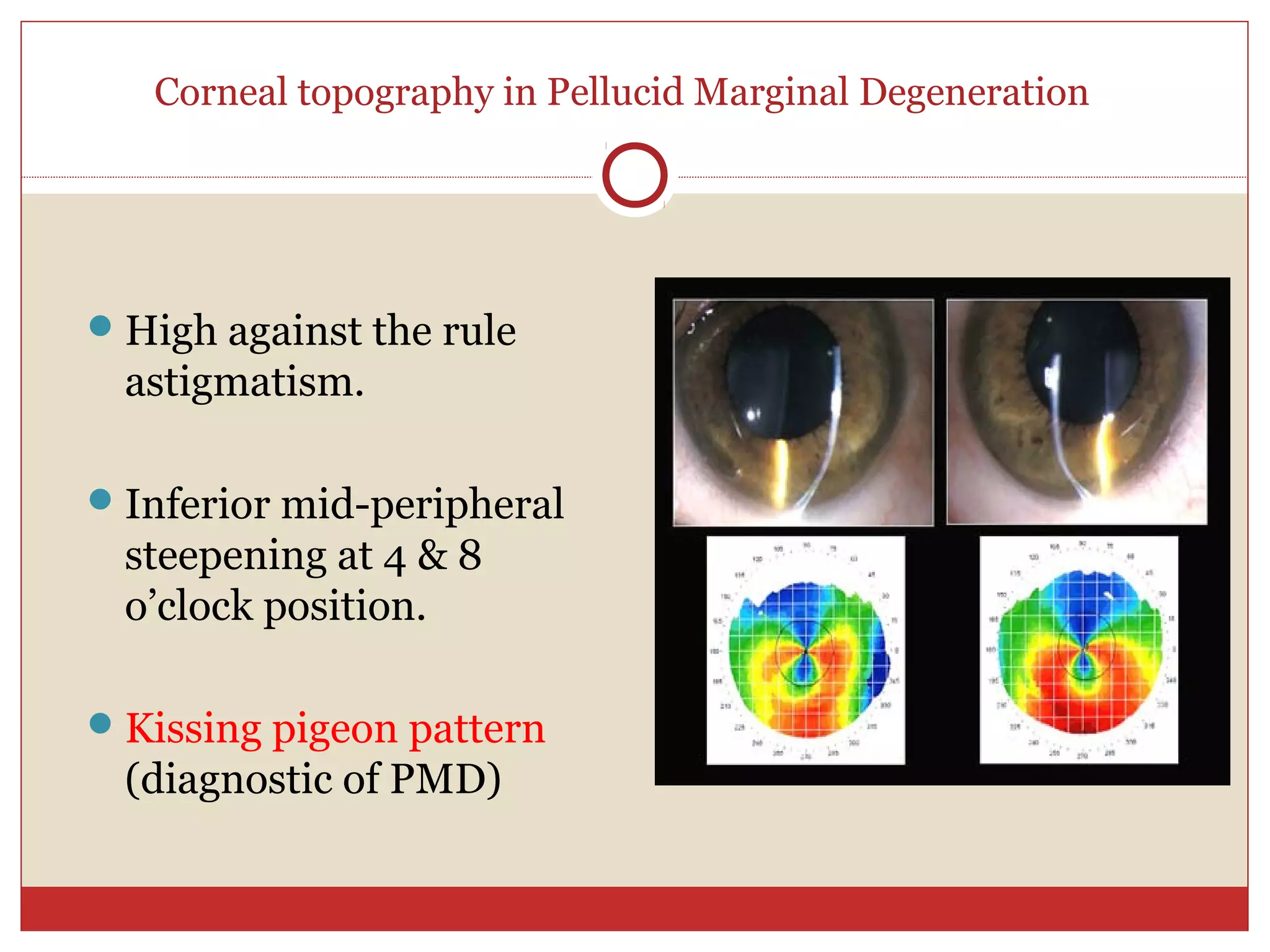 Corneal topography in Pellucid Marginal Degeneration
High against the rule
astigmatism.
Inferior mid-peripheral
steepening at 4 & 8
o’clock position.
Kissing pigeon pattern
(diagnostic of PMD)
 