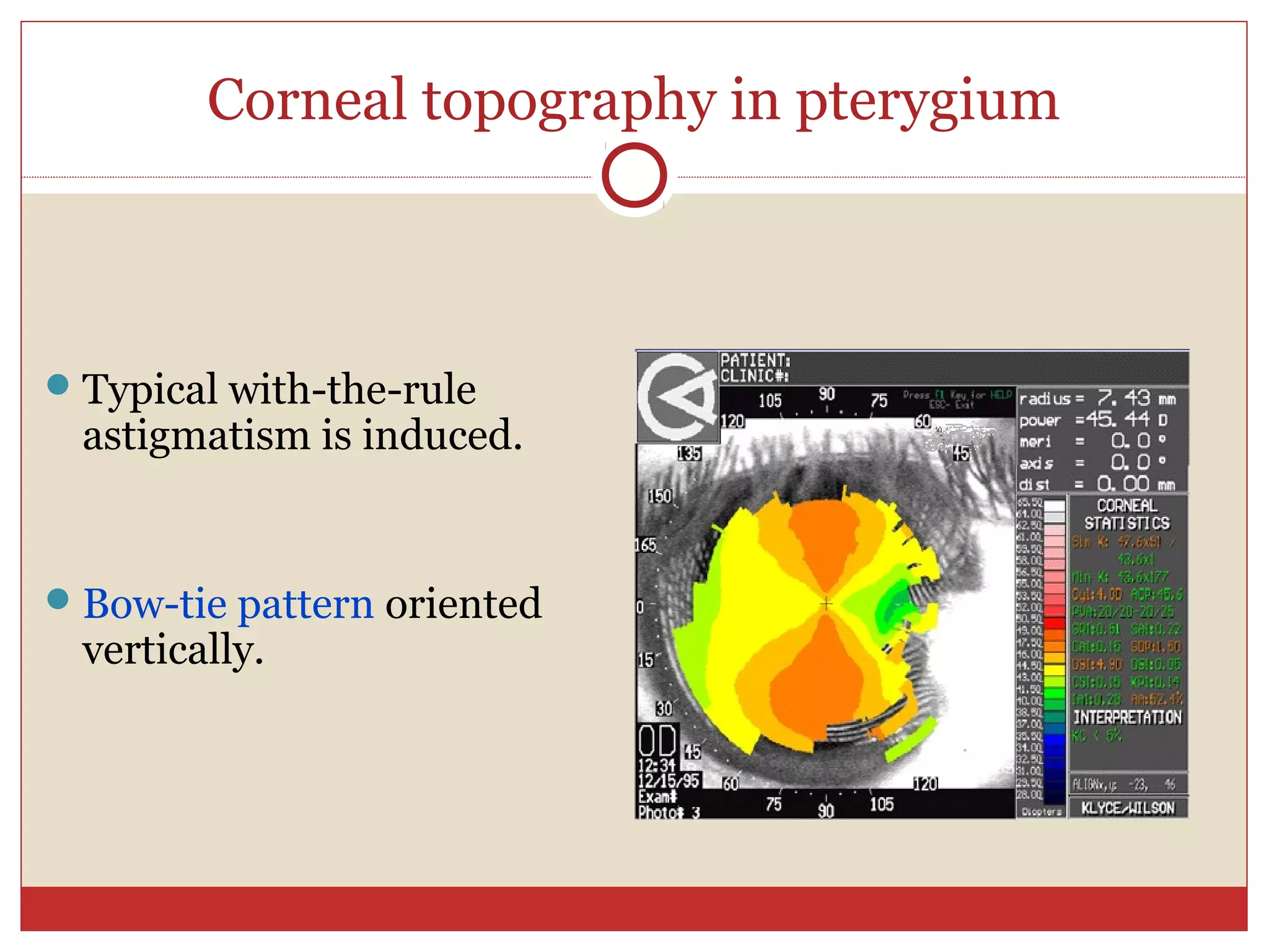 Corneal topography in pterygium
Typical with-the-rule
astigmatism is induced.
Bow-tie pattern oriented
vertically.
 
