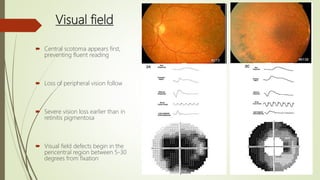 Visual field
 Central scotoma appears first,
preventing fluent reading
 Loss of peripheral vision follow
 Severe vision loss earlier than in
retinitis pigmentosa
 Visual field defects begin in the
pericentral region between 5-30
degrees from fixation
 