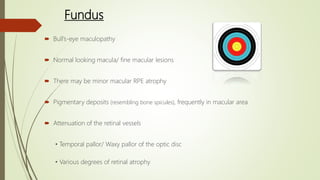 Fundus
 Bull’s-eye maculopathy
 Normal looking macula/ fine macular lesions
 There may be minor macular RPE atrophy
 Pigmentary deposits (resembling bone spicules), frequently in macular area
 Attenuation of the retinal vessels
• Temporal pallor/ Waxy pallor of the optic disc
• Various degrees of retinal atrophy
 