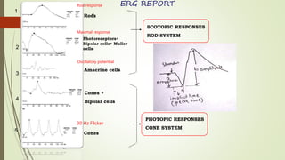17
1
4
3
2
5
SCOTOPIC RESPONSES
ROD SYSTEM
PHOTOPIC RESPONSES
CONE SYSTEM
ERG REPORT
Rods
Photoreceptors+
Bipolar cells+ Muller
cells
Amacrine cells
Cones +
Bipolar cells
Cones
30 Hz Flicker
Rod response
Maximal response
Oscillatory potential
 