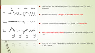  Predominant involvement of photopic (cones) over scotopic (rods)
responses
 Earliest ERG finding: Delayed 30 Hz flicker implicit time
 Followed by deterioration of the 30 Hz flicker ERG amplitude
 Reduced a-wave and b-wave amplitudes of the single flash photopic
ERG
 Scotopic function is preserved in early disease, but is usually affected
in late disease.
 