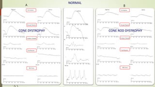 19
CONE DYSTROPHY
NORMAL
CONE ROD DYSTROPHY
A B
 