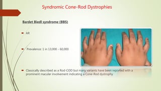Syndromic Cone-Rod Dystrophies
Bardet Biedl syndrome (BBS)
 AR
 Prevalence: 1 in 13,000 - 60,000
 Classically described as a Rod-COD but many variants have been reported with a
prominent macular involvement indicating a Cone-Rod dystrophy
 