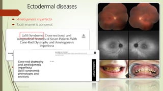 Ectodermal diseases
 Amelogenesis imperfecta
 Tooth enamel is abnormal.
 One form of amelogenesis imperfecta with AR inheritance is
associated with CRD and abnormally shaped teeth
 