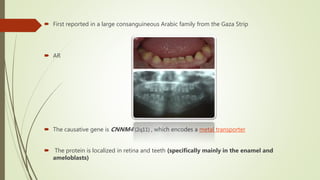  First reported in a large consanguineous Arabic family from the Gaza Strip
 AR
 The causative gene is CNNM4 (2q11) , which encodes a metal transporter
 The protein is localized in retina and teeth (specifically mainly in the enamel and
ameloblasts)
 