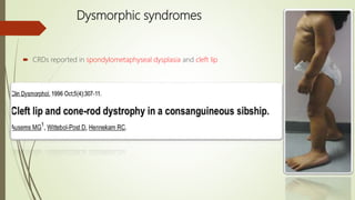 Dysmorphic syndromes
 CRDs reported in spondylometaphyseal dysplasia and cleft lip
 