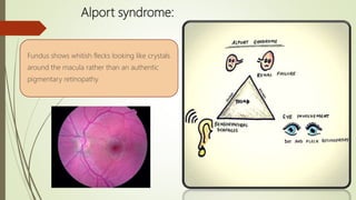 Alport syndrome:
Fundus shows whitish flecks looking like crystals
around the macula rather than an authentic
pigmentary retinopathy
 