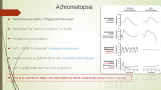 Achromatopsia
 “Rod monochromatism” / “Oligocone trichromacy“
 Presentation by 6 months, Incidence: 1 in 30,000
 Photophobia and nystagmus
 V/A < 20/200 for those with complete achromatopsia
 May be as good as 20/80 for those with incomplete achromatopsia
 V/A is usually stable overtime ( non progressive )
 This is in contrast to other cone dystrophies in which visual acuity progressively worsens
 