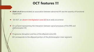 OCT features !!!
 Oishi et al demonstrated an association between abnormal AF and the severity of functional
impairment
 On OCT, an absent interdigitation zone (IZ) is an early occurrence
 IZ is a band representing the interaction between apical processes of the RPE and
photoreceptor OS
 Progressive disruption and loss of the ellipsoid zone (EZ)
(EZ corresponds to the ellipsoid portion of the photoreceptor inner segment)
 