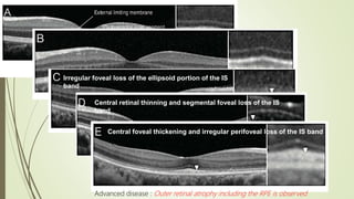 Irregular foveal loss of the ellipsoid portion of the IS
band
Central retinal thinning and segmental foveal loss of the IS
band
Central foveal thickening and irregular perifoveal loss of the IS band
Advanced disease : Outer retinal atrophy including the RPE is observed
 