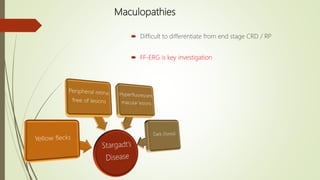 Maculopathies
 Difficult to differentiate from end stage CRD / RP
 FF-ERG is key investigation
 