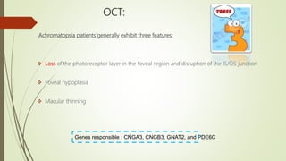OCT:
Achromatopsia patients generally exhibit three features:
 Loss of the photoreceptor layer in the foveal region and disruption of the IS/OS junction
 Foveal hypoplasia
 Macular thinning
Genes responsible : CNGA3, CNGB3, GNAT2, and PDE6C
 