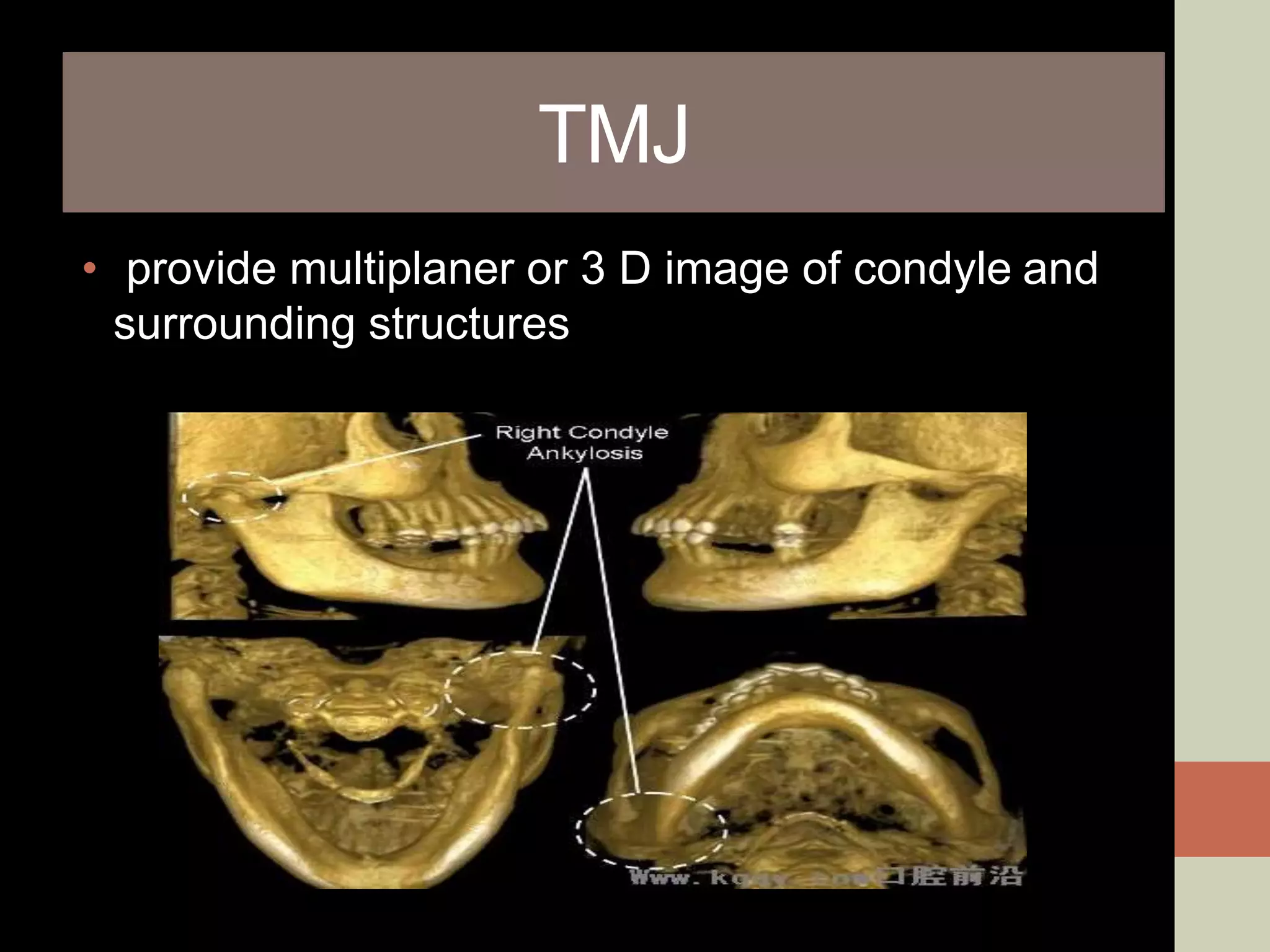 TMJ
• provide multiplaner or 3 D image of condyle and
surrounding structures
 