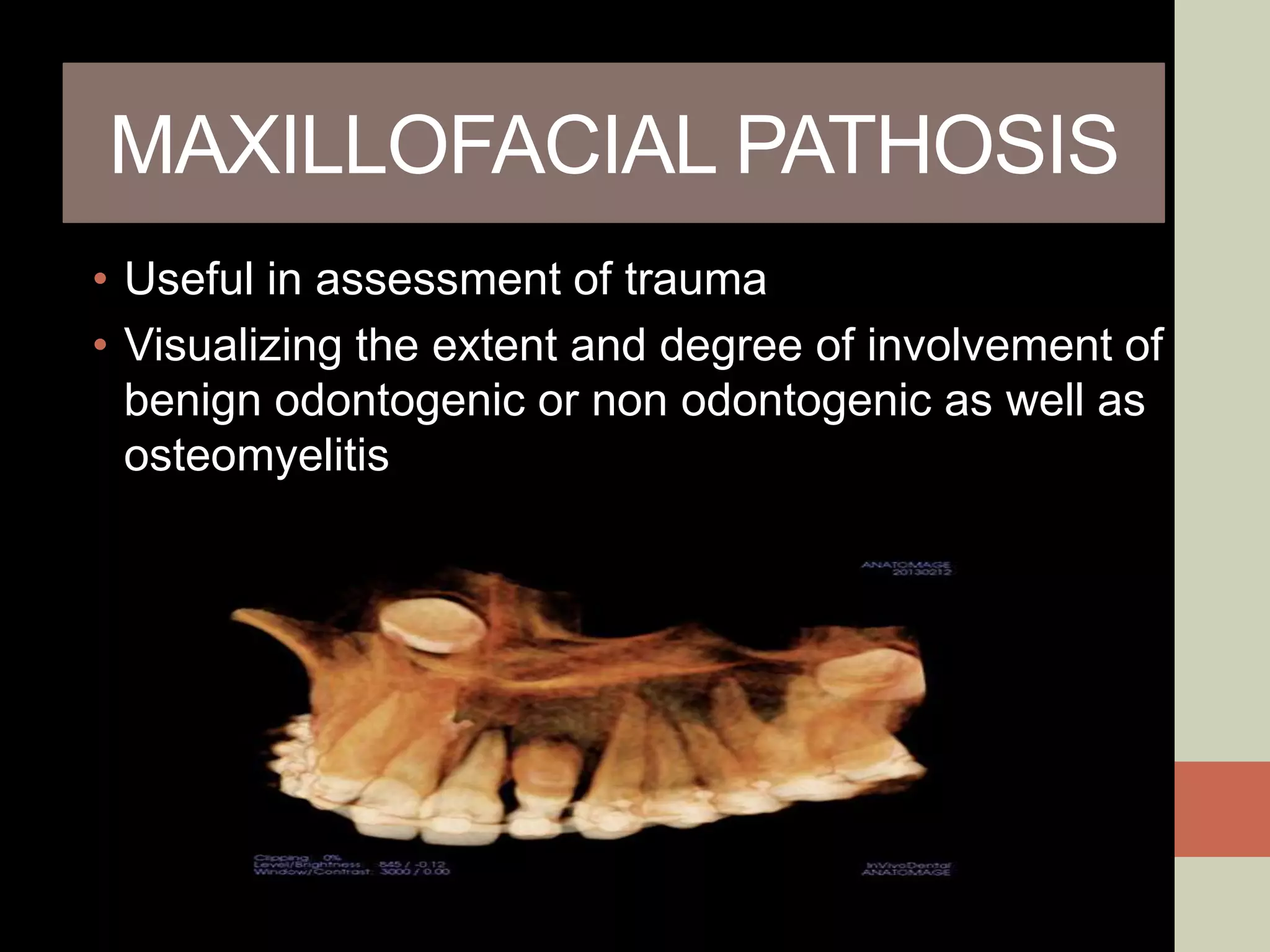 MAXILLOFACIAL PATHOSIS
• Useful in assessment of trauma
• Visualizing the extent and degree of involvement of
benign odontogenic or non odontogenic as well as
osteomyelitis
 