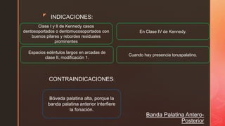 z
Banda Palatina Antero-
Posterior
INDICACIONES:
Clase I y II de Kennedy casos
dentosoportados o dentomucosoportados con
buenos pilares y rebordes residuales
prominentes
En Clase IV de Kennedy.
Espacios edéntulos largos en arcadas de
clase II, modificación 1.
Cuando hay presencia toruspalatino.
CONTRAINDICACIONES:
Bóveda palatina alta, porque la
banda palatina anterior interfiere
la fonación.
 