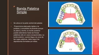 zz
Banda Palatina
Simple
 Se ubica en la parte central del paladar.
 Proporciona adecuada rigidez a la
prótesis y comodidad al paciente porque
es plana y ancha; su borde posterior
puede extenderse hasta las fóveas
palatinas sólo en casos excepcionales, su
borde anterior, cuando llega a la zona de
las rugas palatinas, debe seguir las
depresiones formadas por éstas.
 