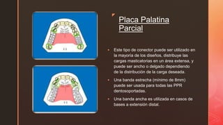 z z
Placa Palatina
Parcial
 Este tipo de conector puede ser utilizado en
la mayoría de los diseños, distribuye las
cargas masticatorias en un área extensa, y
puede ser ancho o delgado dependiendo
de la distribución de la carga deseada.
 Una banda estrecha (mínimo de 8mm)
puede ser usada para todas las PPR
dentosoportadas.
 Una banda ancha es utilizada en casos de
bases a extensión distal.
 