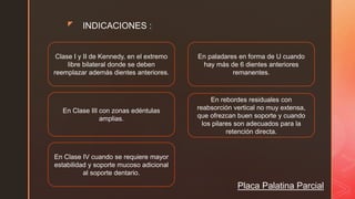 z
Placa Palatina Parcial
INDICACIONES :
Clase I y II de Kennedy, en el extremo
libre bilateral donde se deben
reemplazar además dientes anteriores.
En Clase III con zonas edéntulas
amplias.
En rebordes residuales con
reabsorción vertical no muy extensa,
que ofrezcan buen soporte y cuando
los pilares son adecuados para la
retención directa.
En paladares en forma de U cuando
hay más de 6 dientes anteriores
remanentes.
En Clase IV cuando se requiere mayor
estabilidad y soporte mucoso adicional
al soporte dentario.
 