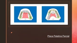 z
z
z
Placa Palatina Parcial
 