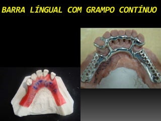 BARRA LÍNGUAL COM GRAMPO CONTÍNUO
 