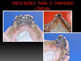 INDICAÇÕES PARA O CHAPEADO
LÍNGUAL
 