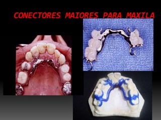 CONECTORES MAIORES PARA MAXILA
 