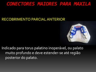 CONECTORES MAIORES PARA MAXILA
RECOBRIMENTO PARCIAL ANTERIOR
Indicado para torus palatino inoperável, ou palato
muito profundo e deve estender-se até região
posterior do palato.
 