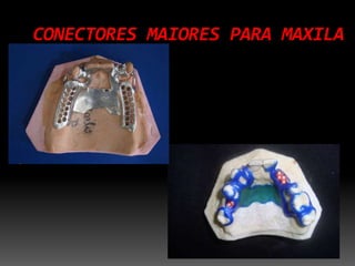 CONECTORES MAIORES PARA MAXILA
 
