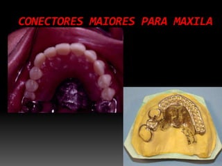 CONECTORES MAIORES PARA MAXILA
 