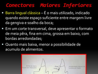 Conectores Maiores Inferiores
 Barra lingual clássica – É o mais utilizado, indicado
quando existe espaço suficiente entre margem livre
da gengiva e soalho da boca;
 Em um corte transversal, deve apresentar o formato
de meia pêra, fina em cima, grossa em baixo, com
bordas arredondadas;
 Quanto mais baixa, menor a possibilidade de
acumulo de alimentos.
 