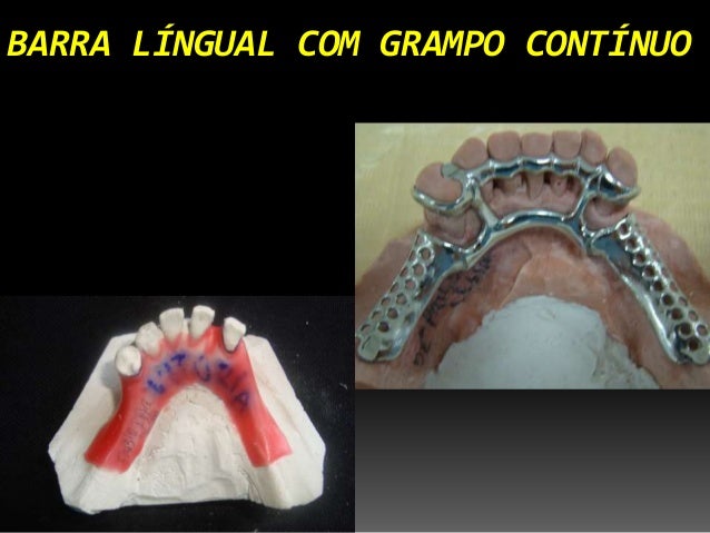 barra lingual superior conectores maiores barra lingual superior conectores maiores