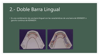 2.- Doble Barra Lingual
• Es una combinación de una barra lingual con las características de una barra de KENNEDY o
gancho continuo de KENNEDY.
 