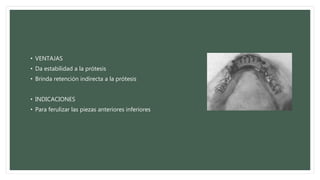 • VENTAJAS
• Da estabilidad a la prótesis
• Brinda retención indirecta a la prótesis
• INDICACIONES
• Para ferulizar las piezas anteriores inferiores
 