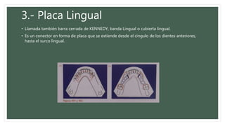 3.- Placa Lingual
• Llamada también barra cerrada de KENNEDY, banda Lingual o cubierta lingual.
• Es un conector en forma de placa que se extiende desde el cíngulo de los dientes anteriores,
hasta el surco lingual.
 