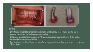 DISEÑO
• En este caso la barra labial tiene en un extremo una bisagra y en el otro un broche que lo
soporta a un eje vertical de la estructura metálica
• En la parte media tiene retenedores en “I” que se apoyan en la zona retentiva de las piezas
periodontalmente comprometidas.
• Éste diseño de combinación de una barra labial con conectores en I se conoce con el nombre de
“Swing-Lock”.
 