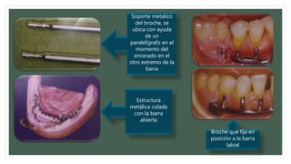 Soporte metalico
del broche, se
ubica con ayuda
de un
paralelígrafo en el
momento del
encerado en el
otro extremo de la
barra
Estructura
metálica colada
con la barra
abierta
Broche que fija en
posición a la barra
labial
 
