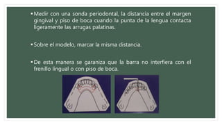 Medir con una sonda periodontal, la distancia entre el margen
gingival y piso de boca cuando la punta de la lengua contacta
ligeramente las arrugas palatinas.
Sobre el modelo, marcar la misma distancia.
De esta manera se garaniza que la barra no interfiera con el
frenillo lingual o con piso de boca.
 