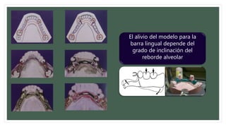 El alivio del modelo para la
barra lingual depende del
grado de inclinación del
reborde alveolar
 