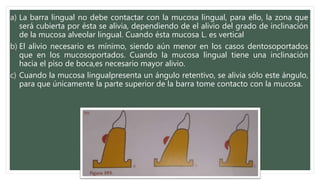 a) La barra lingual no debe contactar con la mucosa lingual, para ello, la zona que
será cubierta por ésta se alivia, dependiendo de el alivio del grado de inclinación
de la mucosa alveolar lingual. Cuando ésta mucosa L. es vertical
b) El alivio necesario es mínimo, siendo aún menor en los casos dentosoportados
que en los mucosoportados. Cuando la mucosa lingual tiene una inclinación
hacia el piso de boca,es necesario mayor alivio.
c) Cuando la mucosa lingualpresenta un ángulo retentivo, se alivia sólo este ángulo,
para que únicamente la parte superior de la barra tome contacto con la mucosa.
 