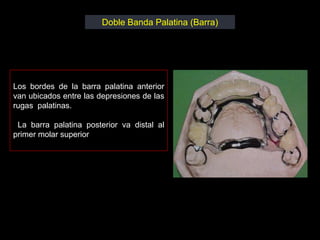 Doble Banda Palatina (Barra)




Los bordes de la barra palatina anterior
van ubicados entre las depresiones de las
rugas palatinas.

 La barra palatina posterior va distal al
primer molar superior
 