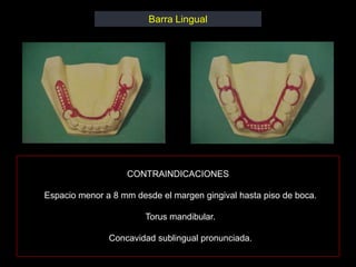Barra Lingual




                   CONTRAINDICACIONES

Espacio menor a 8 mm desde el margen gingival hasta piso de boca.

                        Torus mandibular.

               Concavidad sublingual pronunciada.
 