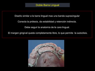 Doble Barra Lingual



      Diseño similar a la barra lingual mas una banda supracingular

         Conecta la prótesis, da estabilidad y retención indirecta.

               Debe seguir la anatomía de la cara lingual.

El margen gingival queda completamente libre, lo que permite la autoclisis.
 